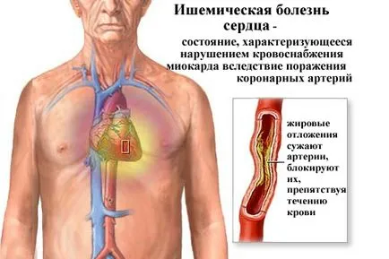 Megsérti a repolarizáció folyamat az EKG diagnózis és kezelés