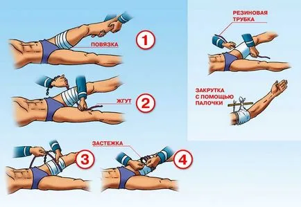 За колко време турникет се прилага при артериална кървене - правила турникет