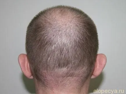 alopecie ereditara la bărbați sau cum să lupte