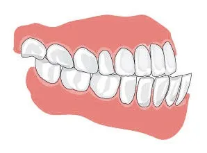 Malocclusion kezelés, a tünetek, etiológia