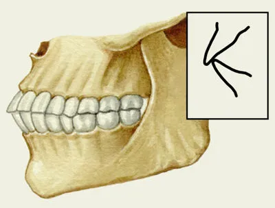 Malocclusion kezelés, a tünetek, etiológia