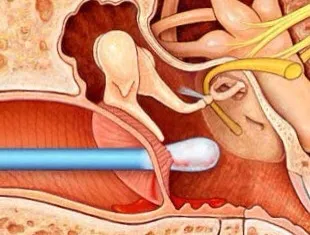 Никога не използвайте памучни тампони за почистване на уши, прочетете настоящата статии и съвети блог