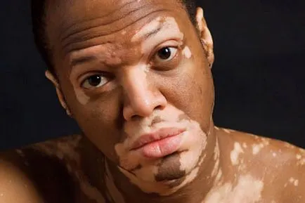 A legújabb kezelési módszerek vitiligo