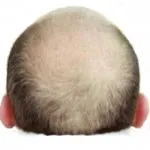 Alopecia, model chelie, alopecie