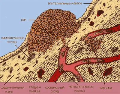 Malignus csonttumorok