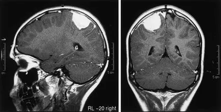 Мозъчен тумор - причини за