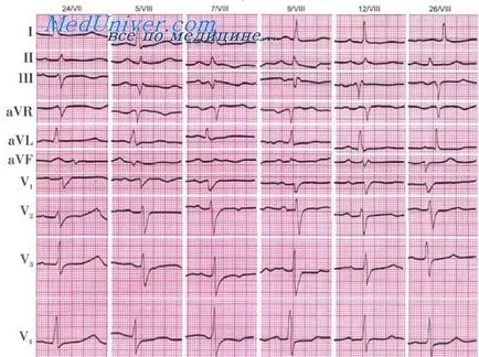 Supraîncărcarea inimii dreapta pe o electrocardiograma