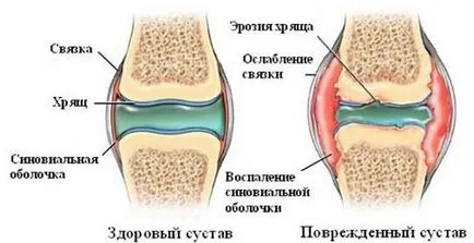 Защо коленете нарани, след пускането на причини, лечение, профилактика