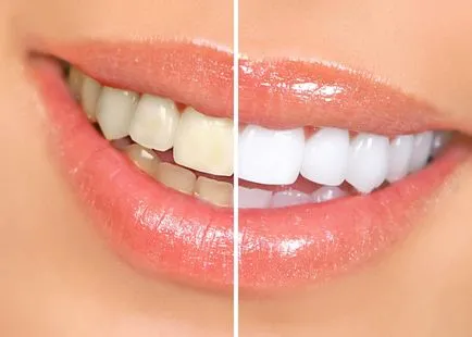 Avantajele și dezavantajele diferitelor metode de albire dentară