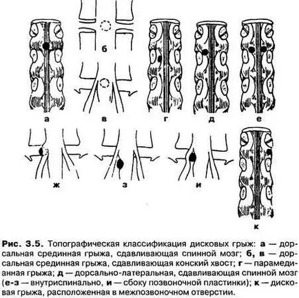 Deteriorarea coloanei vertebrale și a articulațiilor, toate coloanei vertebrale