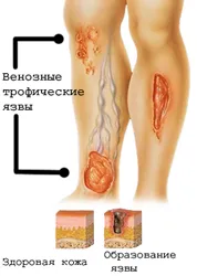 Профилактика на венозни язви по краката