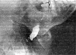 sialadenită ductală cronice (angiosialitis) - stomatologie, glandelor salivare - Chirurgie si tratament