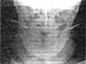 sialadenită ductală cronice (angiosialitis) - stomatologie, glandelor salivare - Chirurgie si tratament