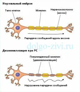 Множествена склероза и как да се научим да живеем с него