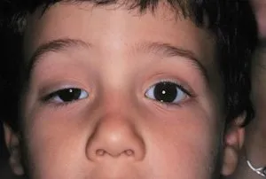 felső szemhéj ptosis gyermekeknél - az egészséges