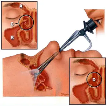 Szúrt a sinusitis