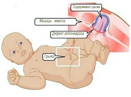 hernie ombilicala la copii, diagnostic și tratament