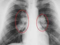 sarcoidoza pulmonară - cauze, simptome, diagnostic și tratament