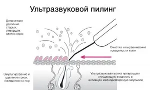 Cel mai nedureroase de curățare facială ultrazvokovym skraberom