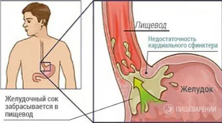 Сърдечна сфинктер на стомаха и на пилора сфинктер