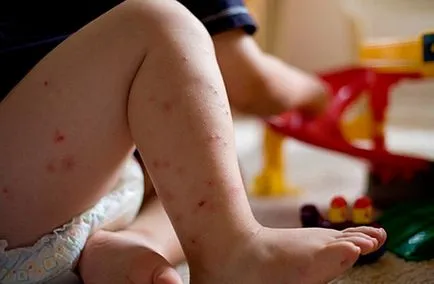 А обрив по краката на детето предизвиква болестни симптоми, лечение, профилактика