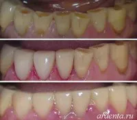 Изтласкване на зъбите - малък дефект или сериозно нарушение на това, което е, причини и лечение на снимка