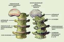 Értágítók nyaki osteochondrosis