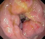 Obstrucționarea colon - cauze, simptome, diagnostic și tratament