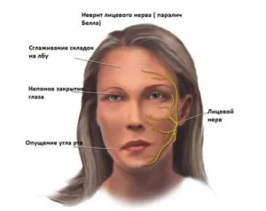 Неврит на лицевия нерв причинява симптомите и последиците от лечението (видео)