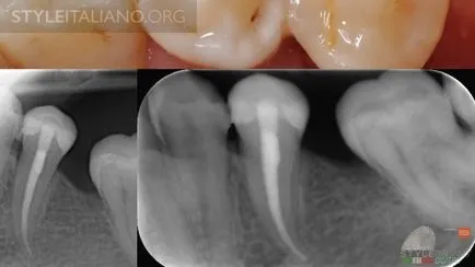 Tehnologia indirectă de restaurare dentară numit digital