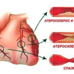 Stenoză a vaselor de simptome cardiace si efecte, uflebologa