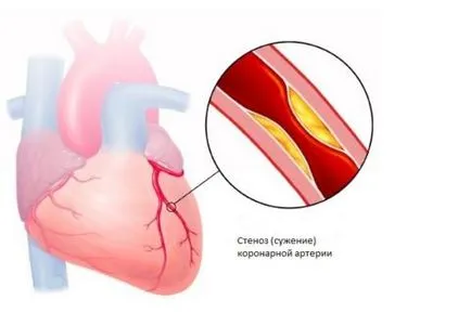 Stenoză a vaselor de simptome cardiace si efecte, uflebologa