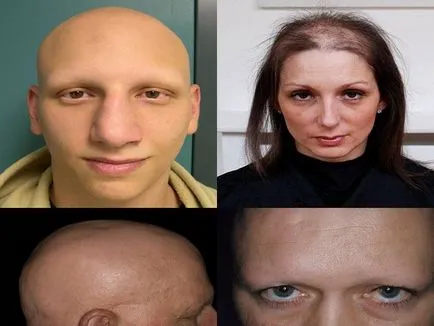 Összesen alopecia okok és a kezelés a nők és férfiak fotók