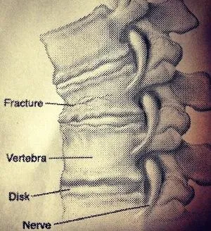 Fisura dintre simptomele coloanei vertebrale si tratament