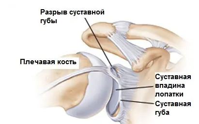 Изкълчи рамото симптоми, лечение, хирургия, рехабилитация след дислокация, обичайното дислокация на рамото