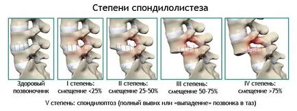 Разместване на лумбалните прешлени (снимка)