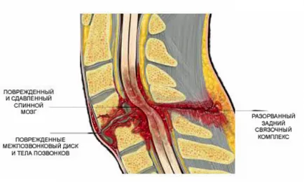 Luxatiei coloanei vertebrale lombare (foto)