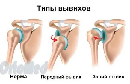 simptome, tratament dislocat umărul, chirurgie, recuperare dupa dislocarea, dislocarea obișnuită a umărului