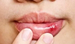 Fekélyek a szájban és a sebek okok és a kezelés otthon