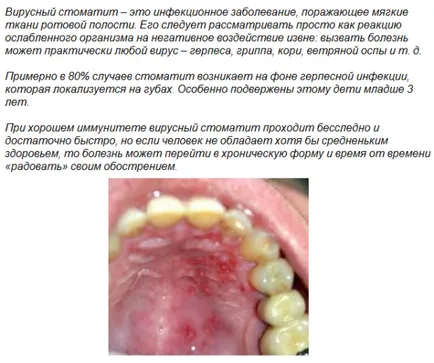 Е заразен стоматит при децата в детайли процедурата на лечение