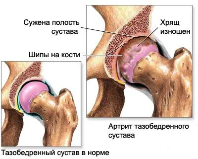 Arthrosis, arthritis