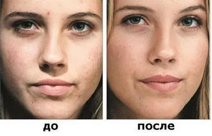 Badyaga a pattanások, mint egy egyedülálló népi orvosság a kezelés utáni acne