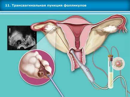 Atlasul tehnicilor de reproducere asistata in tratamentul infertilitatii