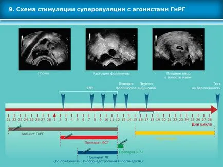 Atlasul tehnicilor de reproducere asistata in tratamentul infertilitatii