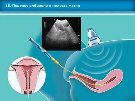 Atlasul tehnicilor de reproducere asistata in tratamentul infertilitatii