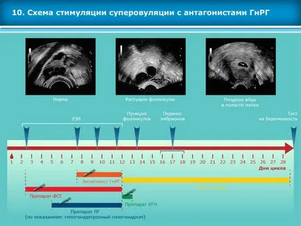 Atlasul tehnicilor de reproducere asistata in tratamentul infertilitatii