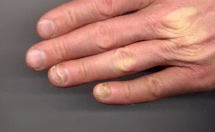Boli ale unghiilor pe mâini - cauze, metode de tratament