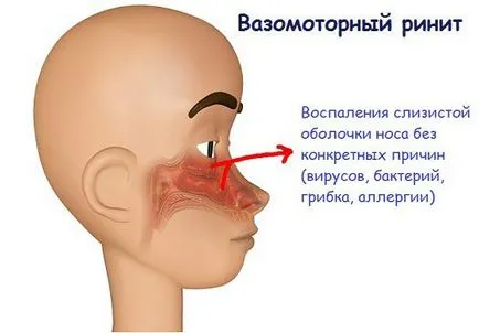 Cum de a trata un nas care curge în timpul sarcinii 2 consecințele pe termen comentarii