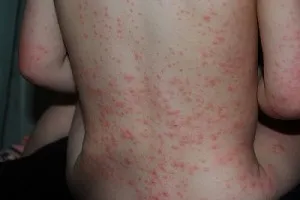 Fertőző és allergiás kiütések gyermekeknél