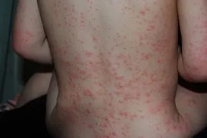 erupții cutanate infecțioase și alergice la copii